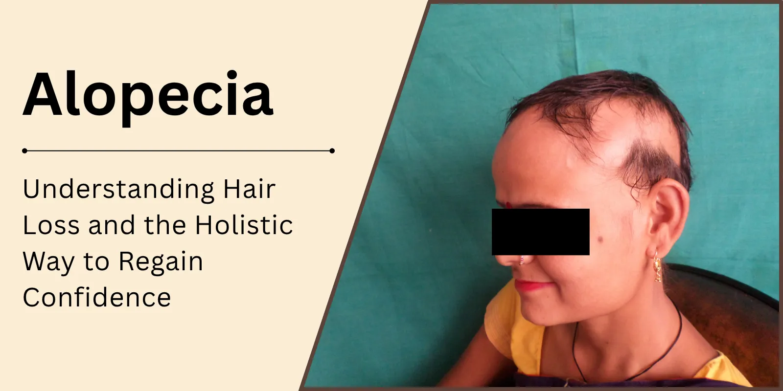Alopecia — Understanding Hair Loss and the Holistic Way to Regain Confidence