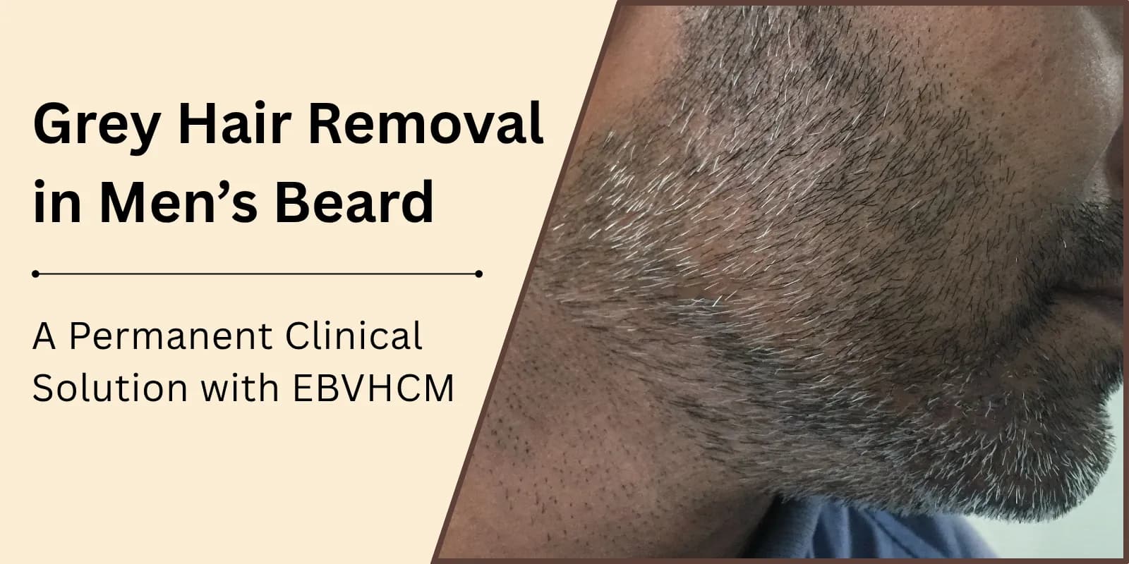 Grey Hair Removal in Men’s Beard: A Permanent Clinical Solution with EBVHCM