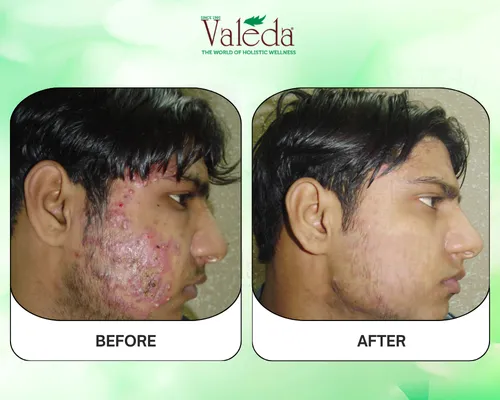 Before & After Pimples Treatment Results