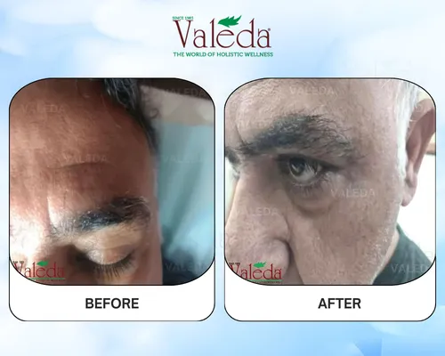 Permanent Hair Removal