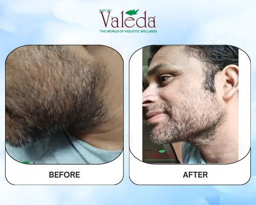 Permanent Hair Removal
