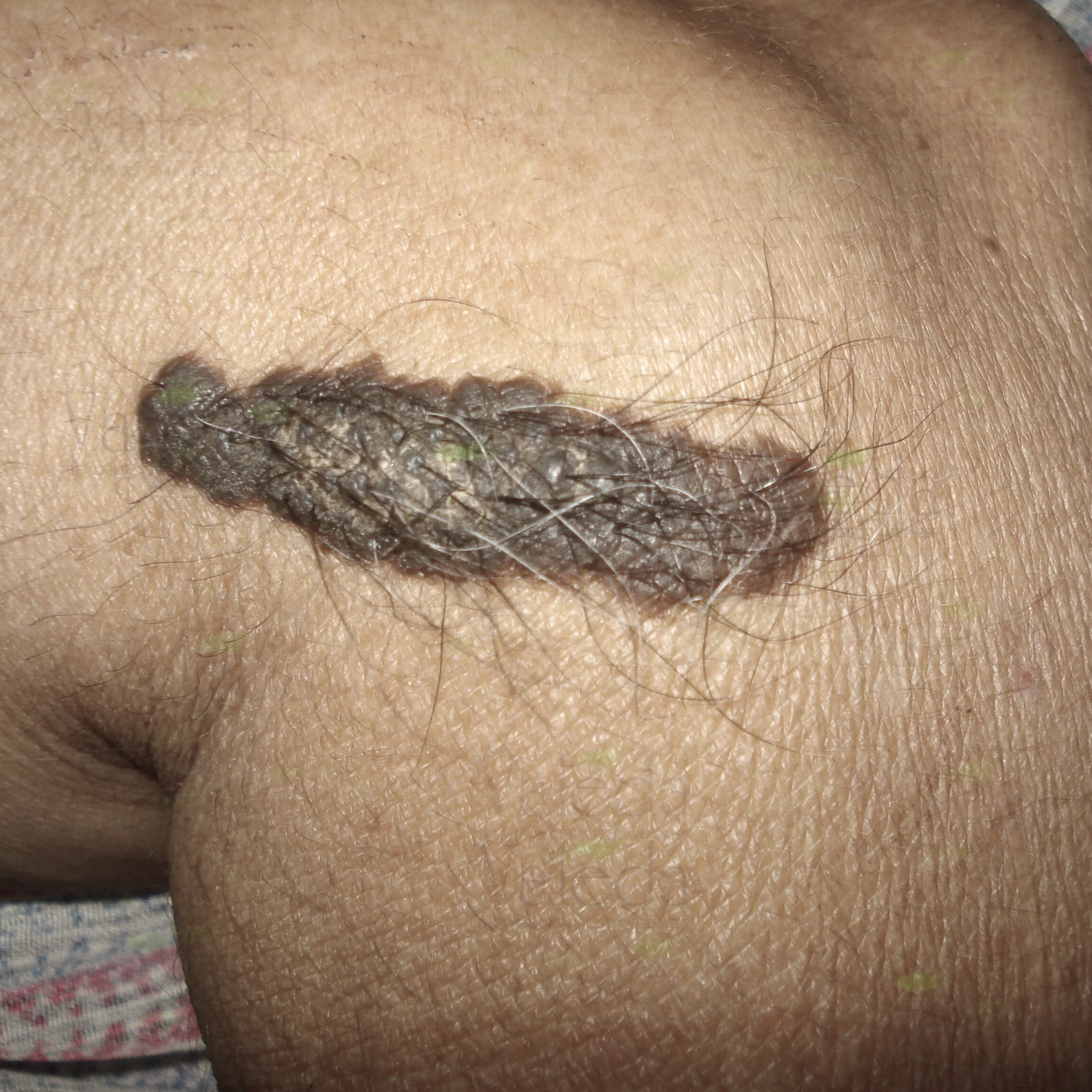 जन्म के निशान (बर्थमार्क)