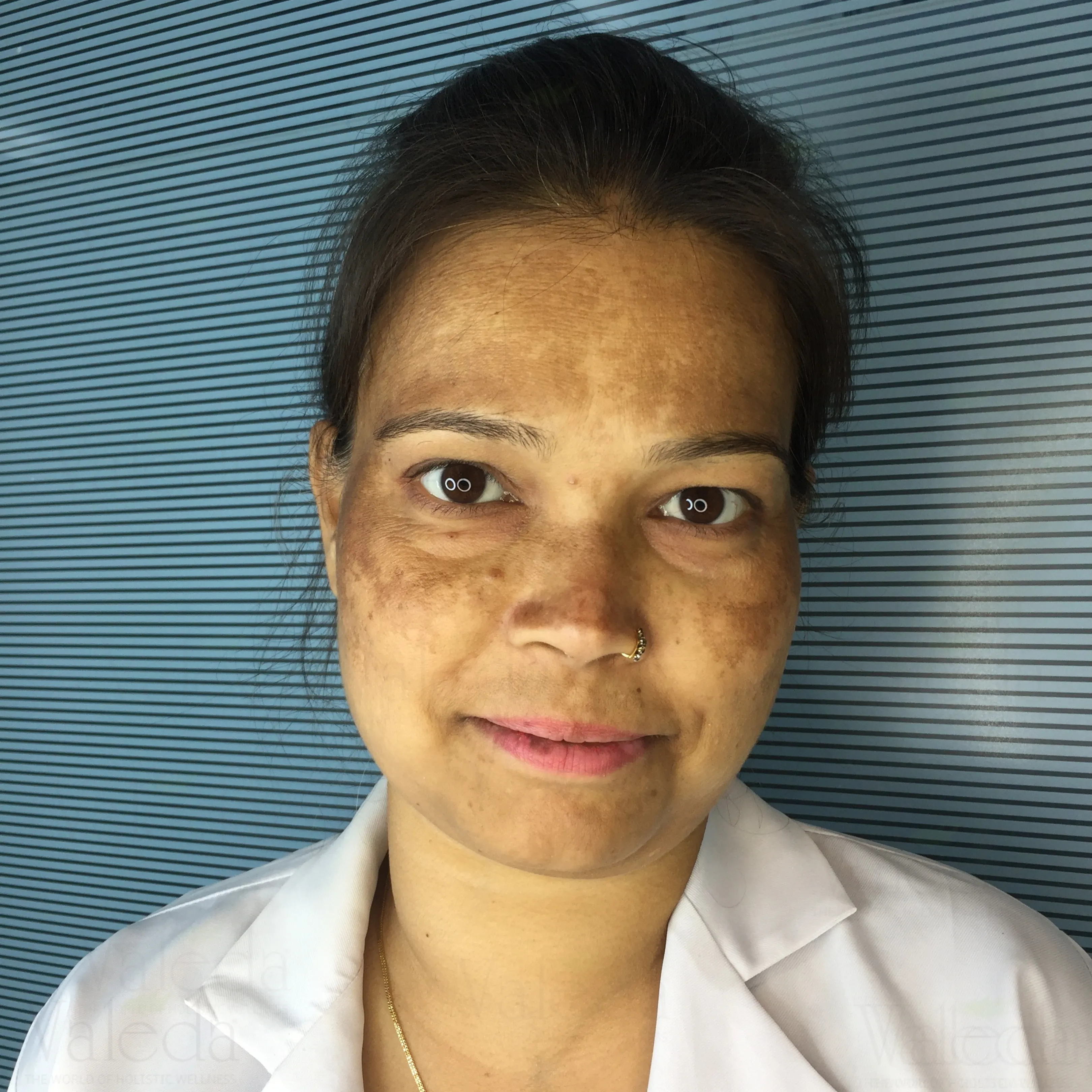 Blemishes & Pigmentation