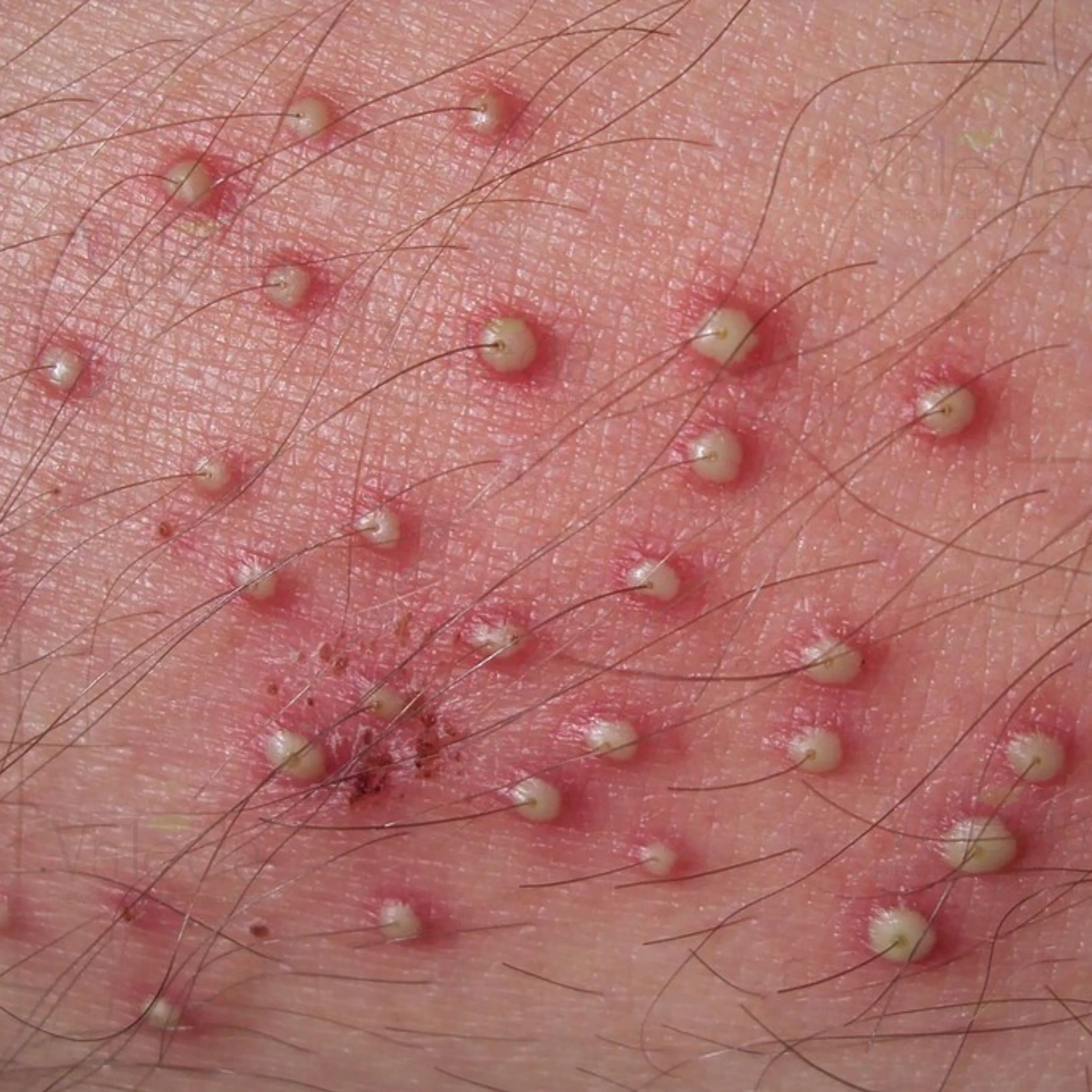 Folliculitis