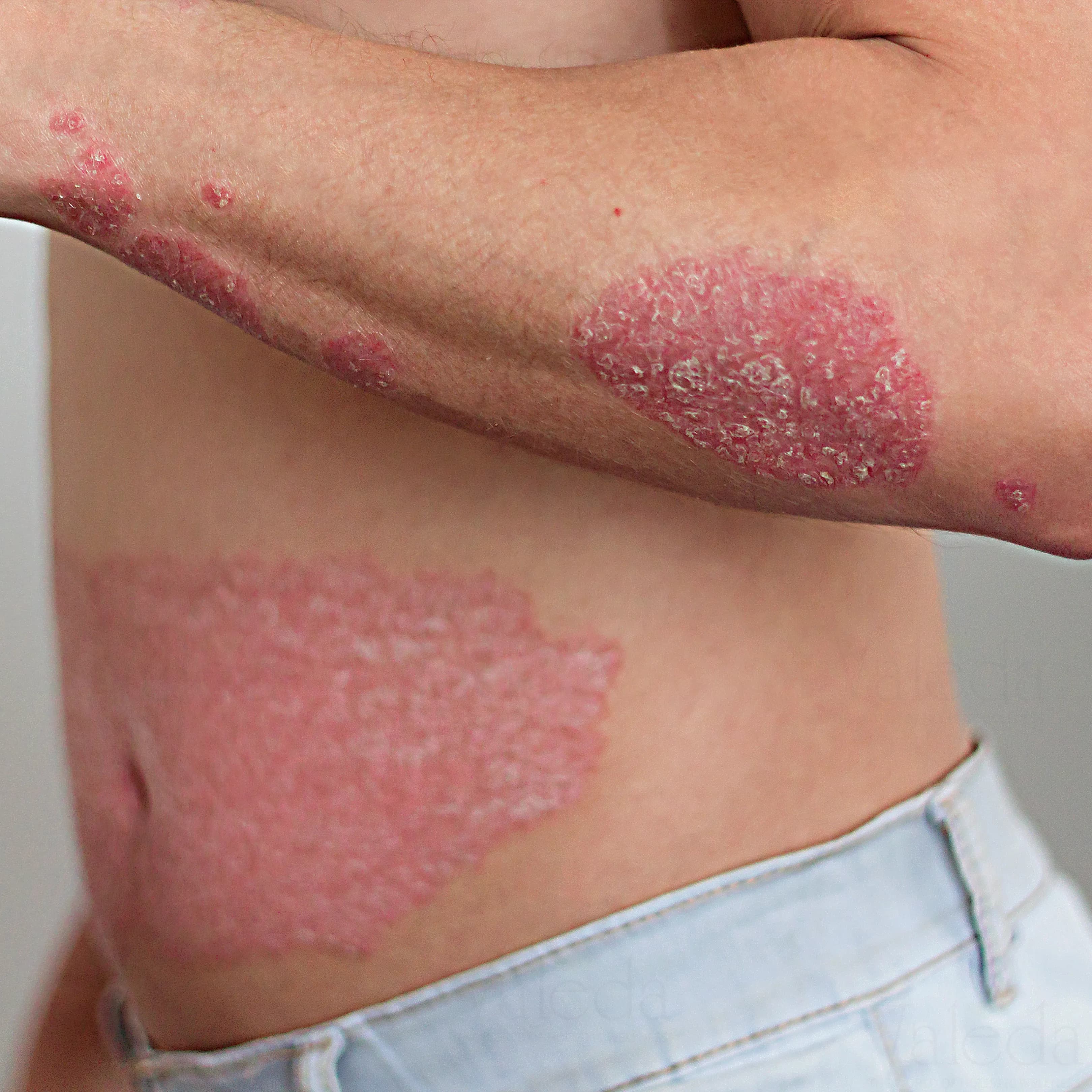 Psoriasis