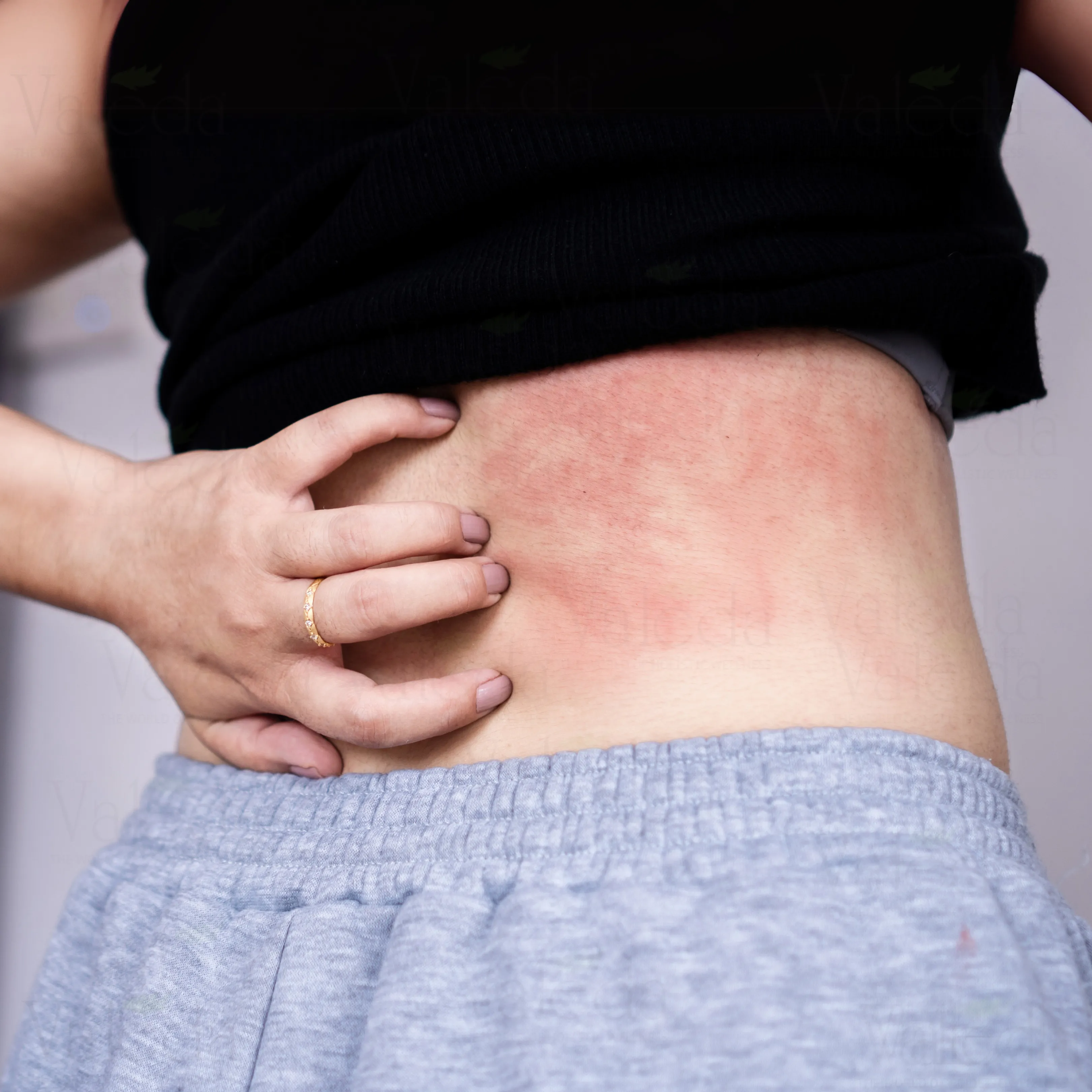 Skin Allergy