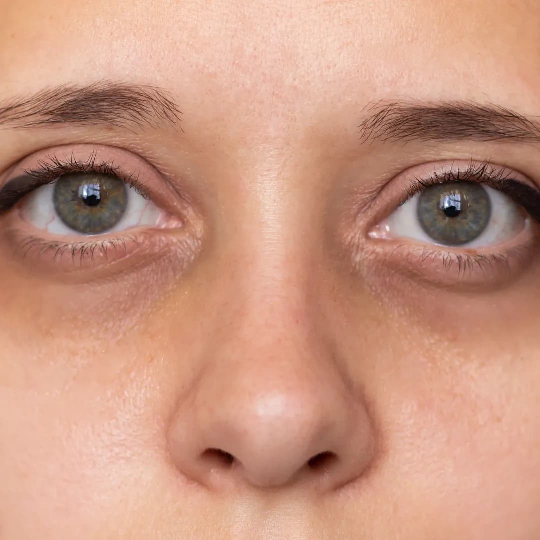 Under Eye Circles