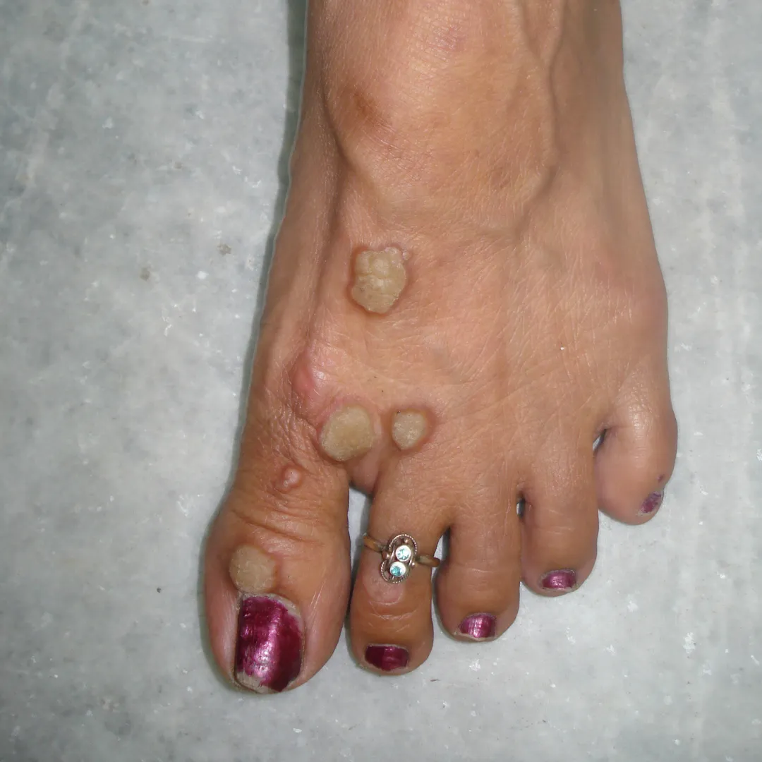 Warts