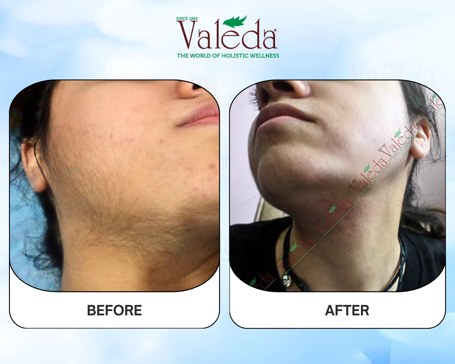 Permanent Hair Removal