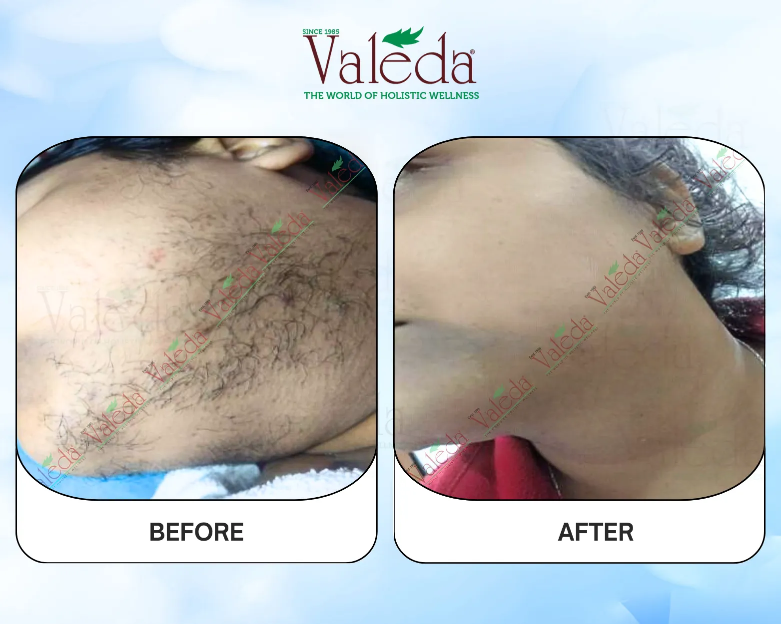 Permanent Hair Removal