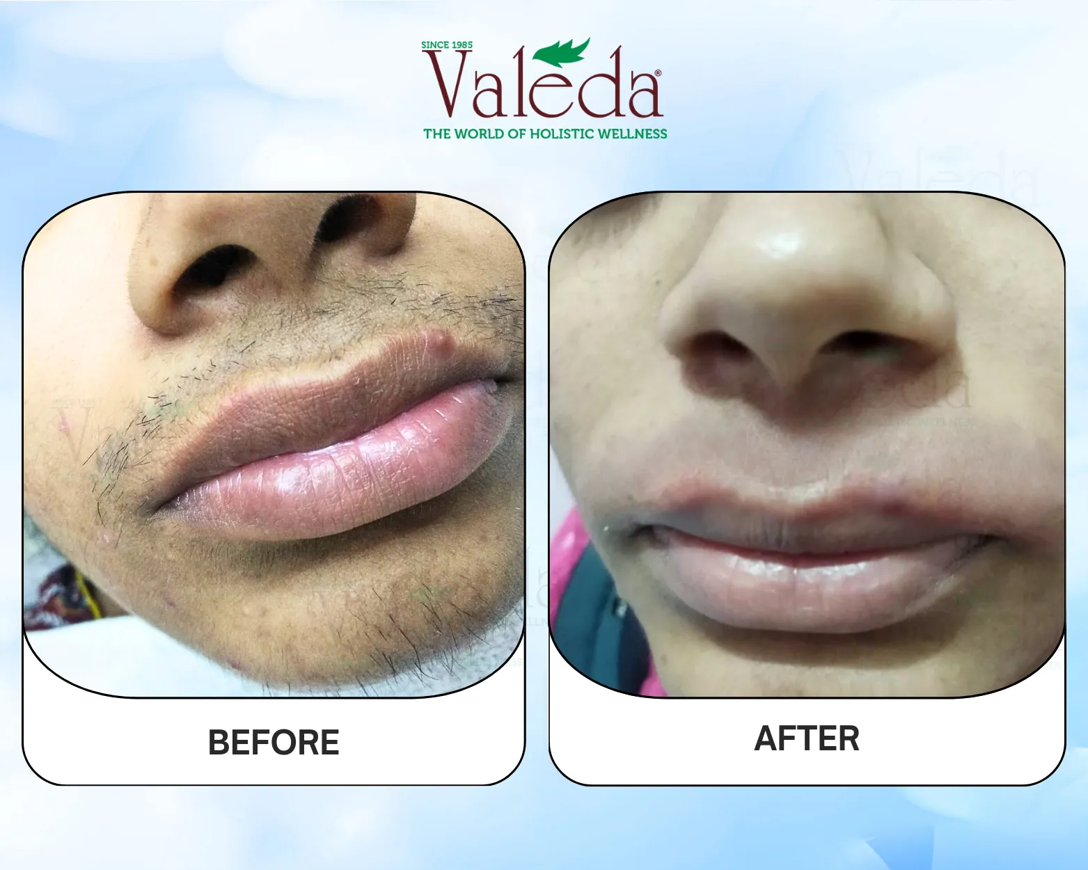 Permanent Hair Removal