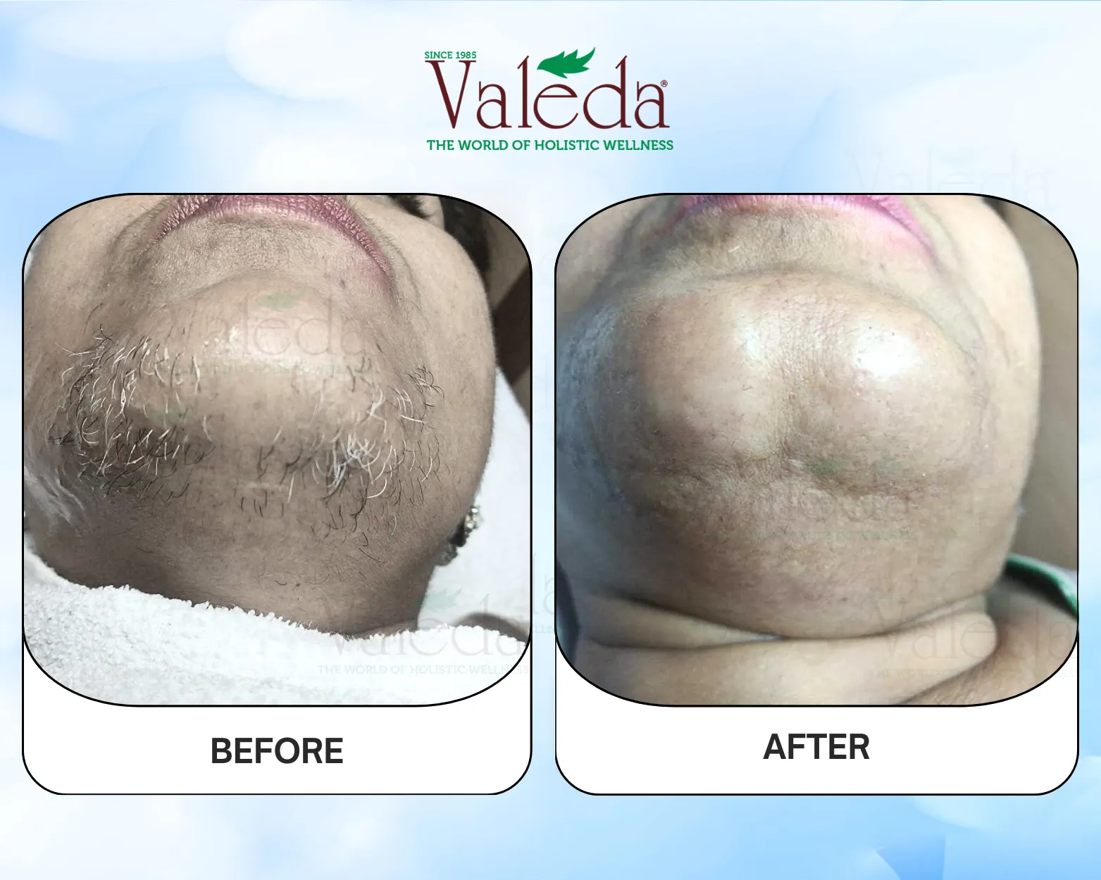 Permanent Hair Removal