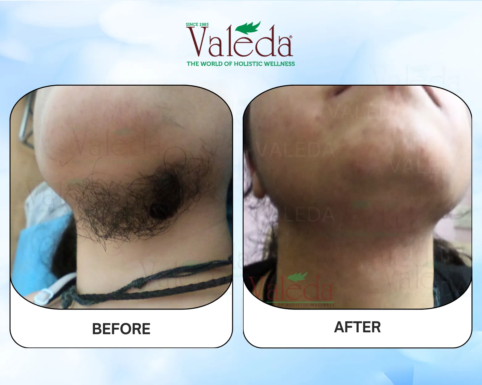 Permanent Hair Removal