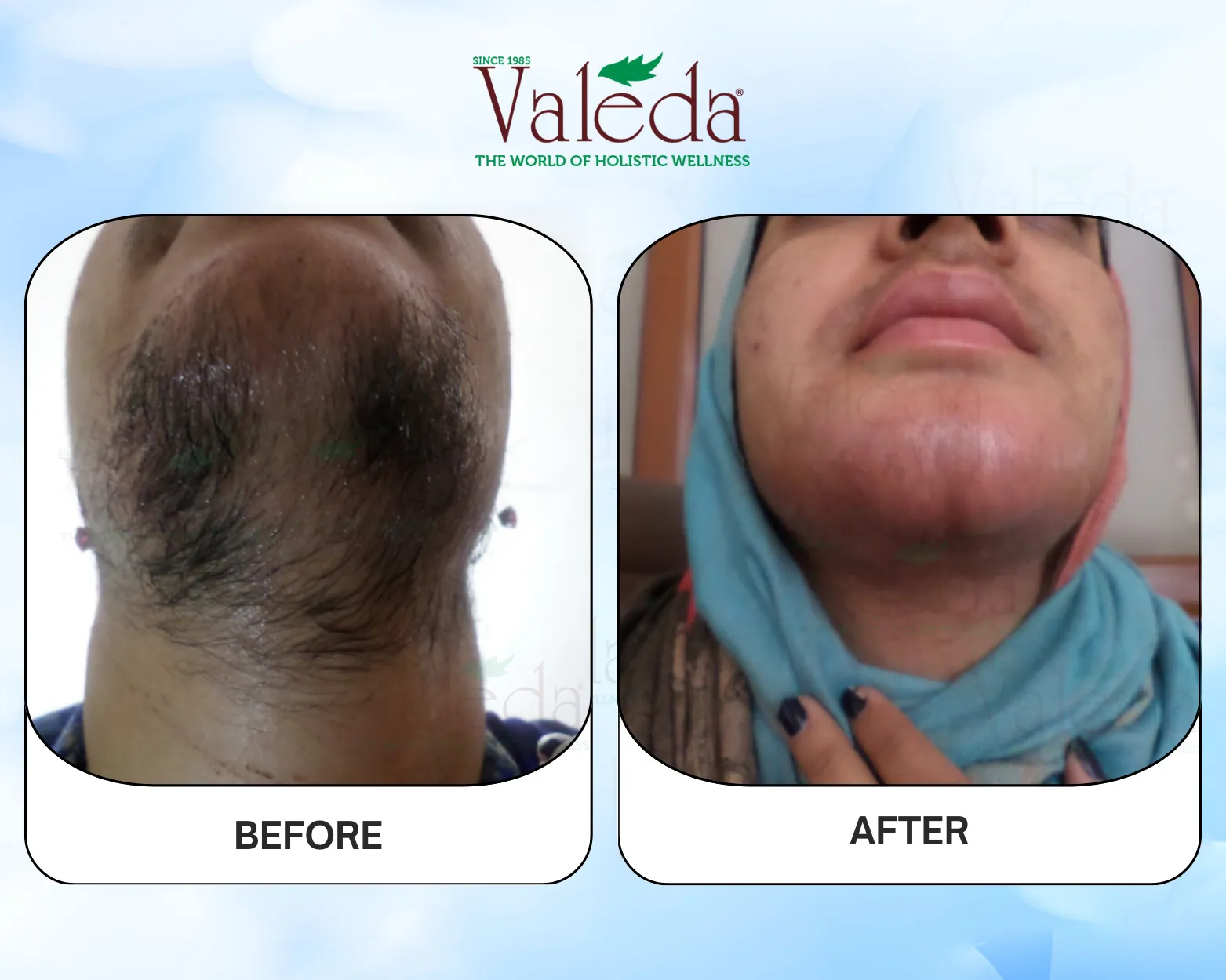 Permanent Hair Removal
