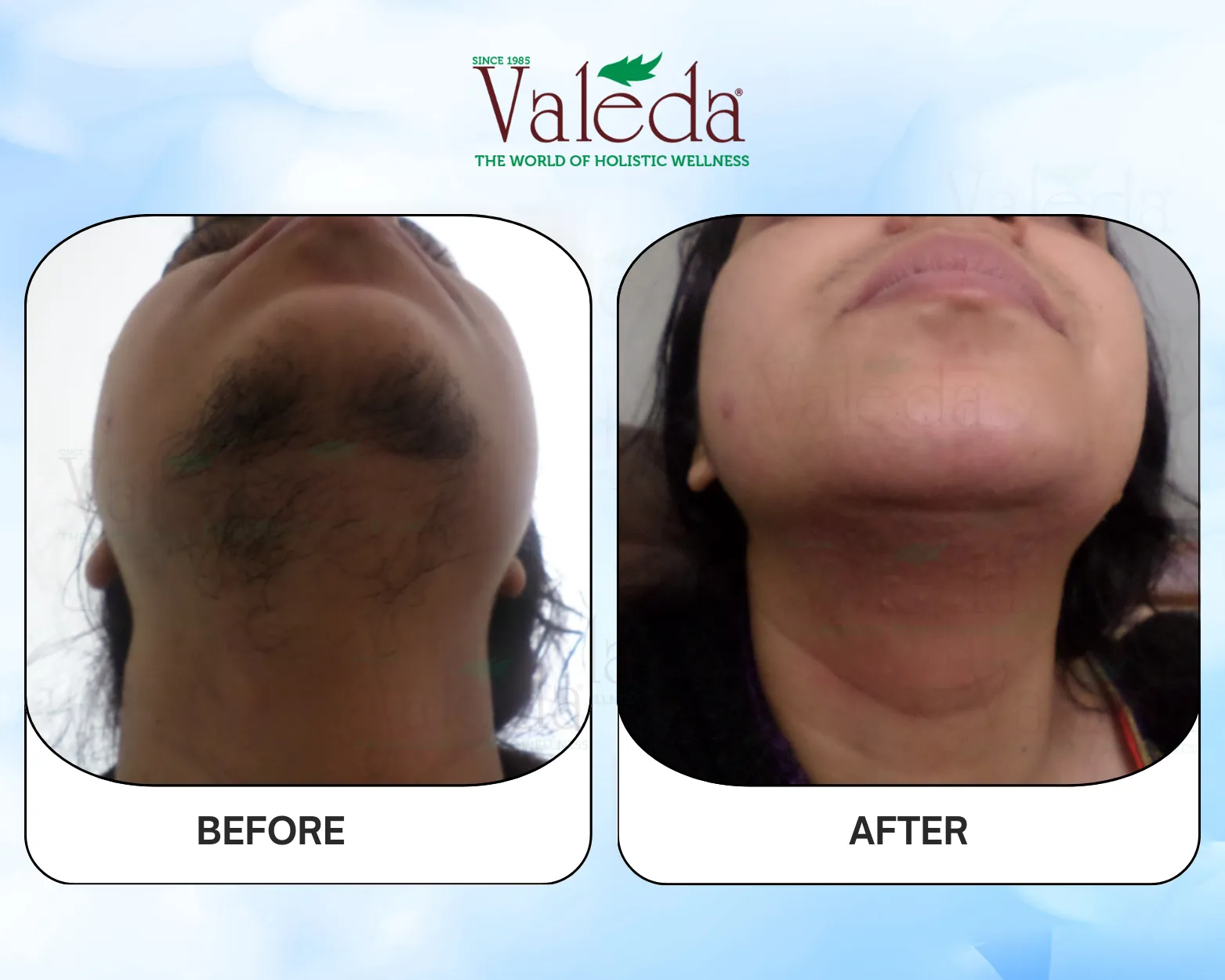 Permanent Hair Removal