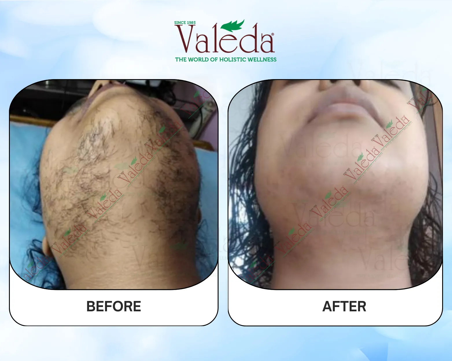 Permanent Hair Removal
