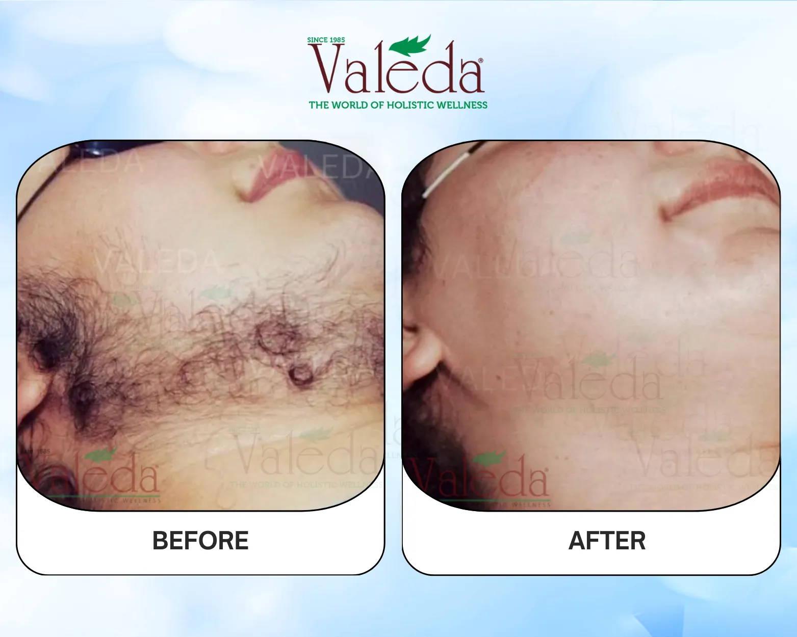 Permanent Hair Removal
