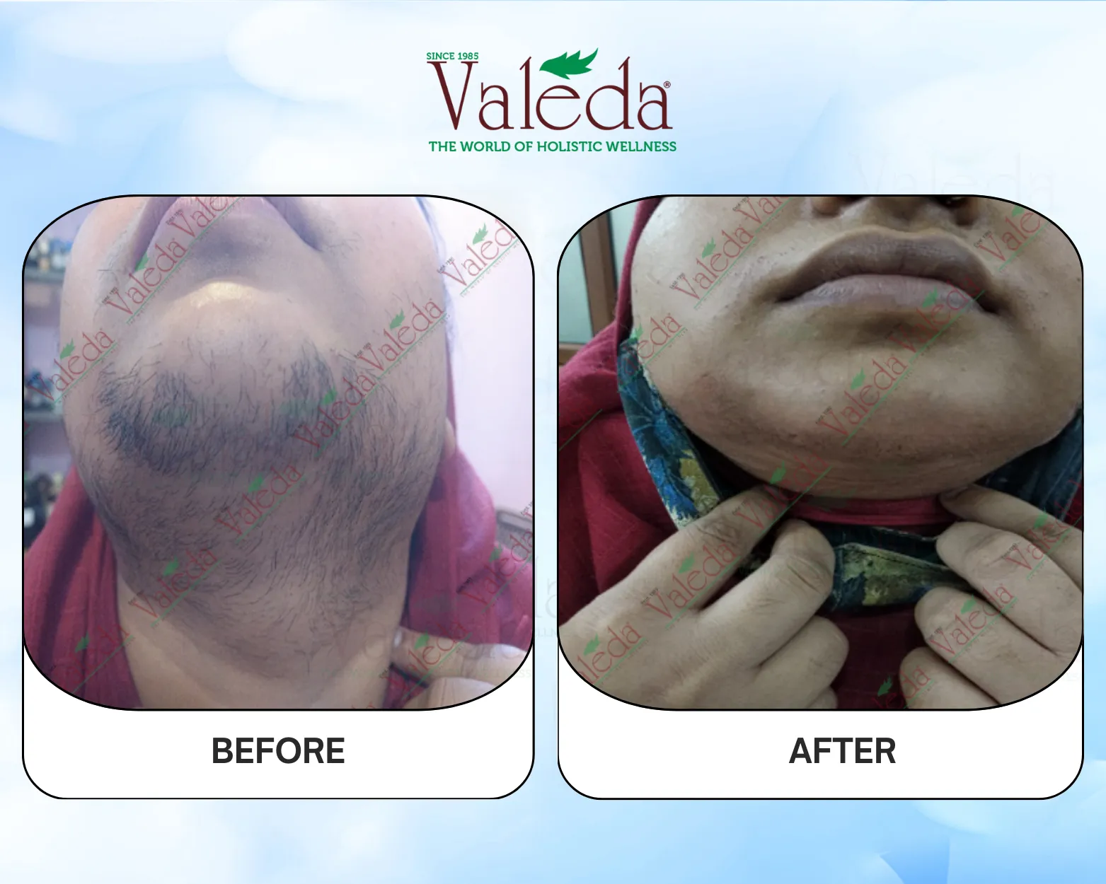 Permanent Hair Removal