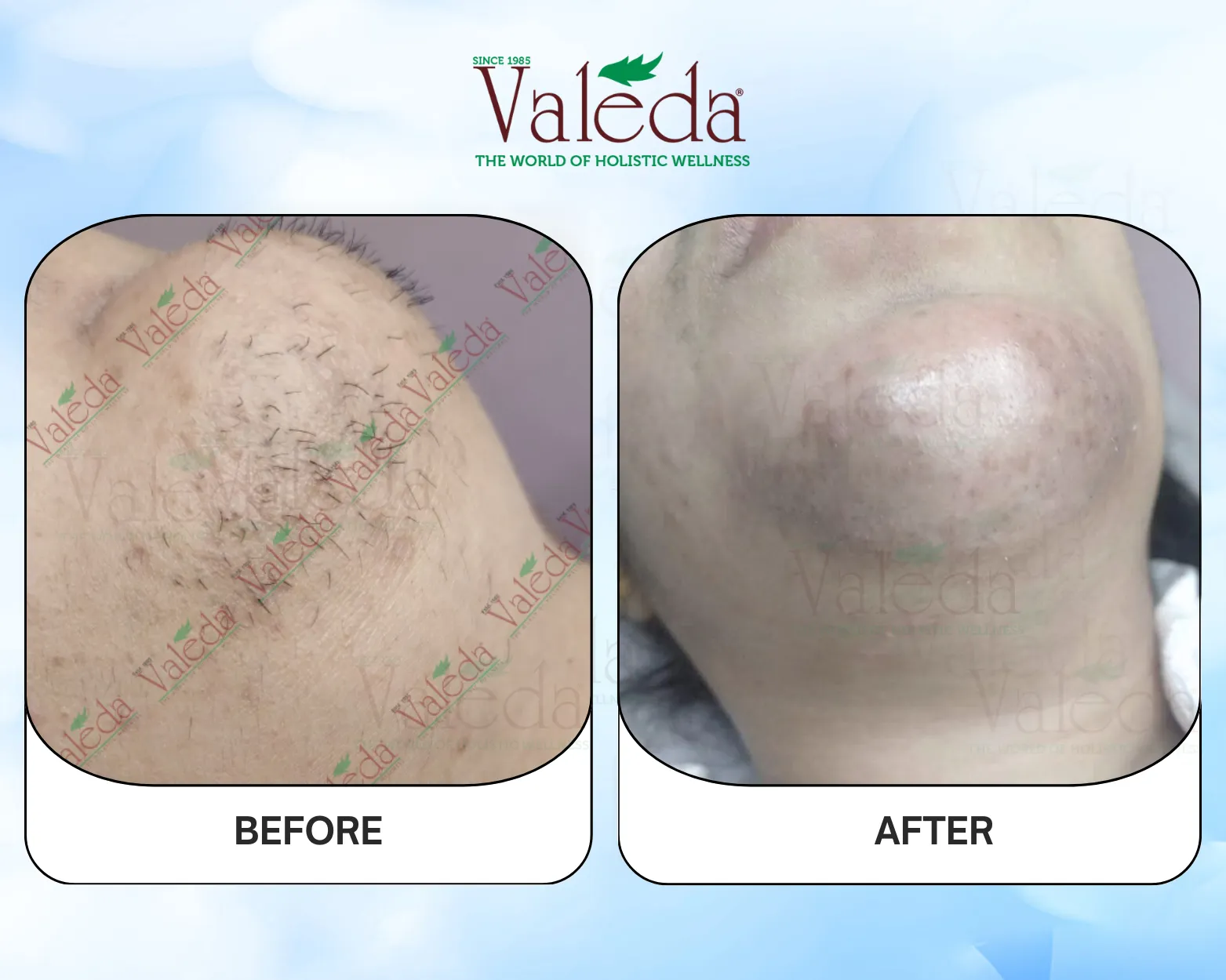 Permanent Hair Removal