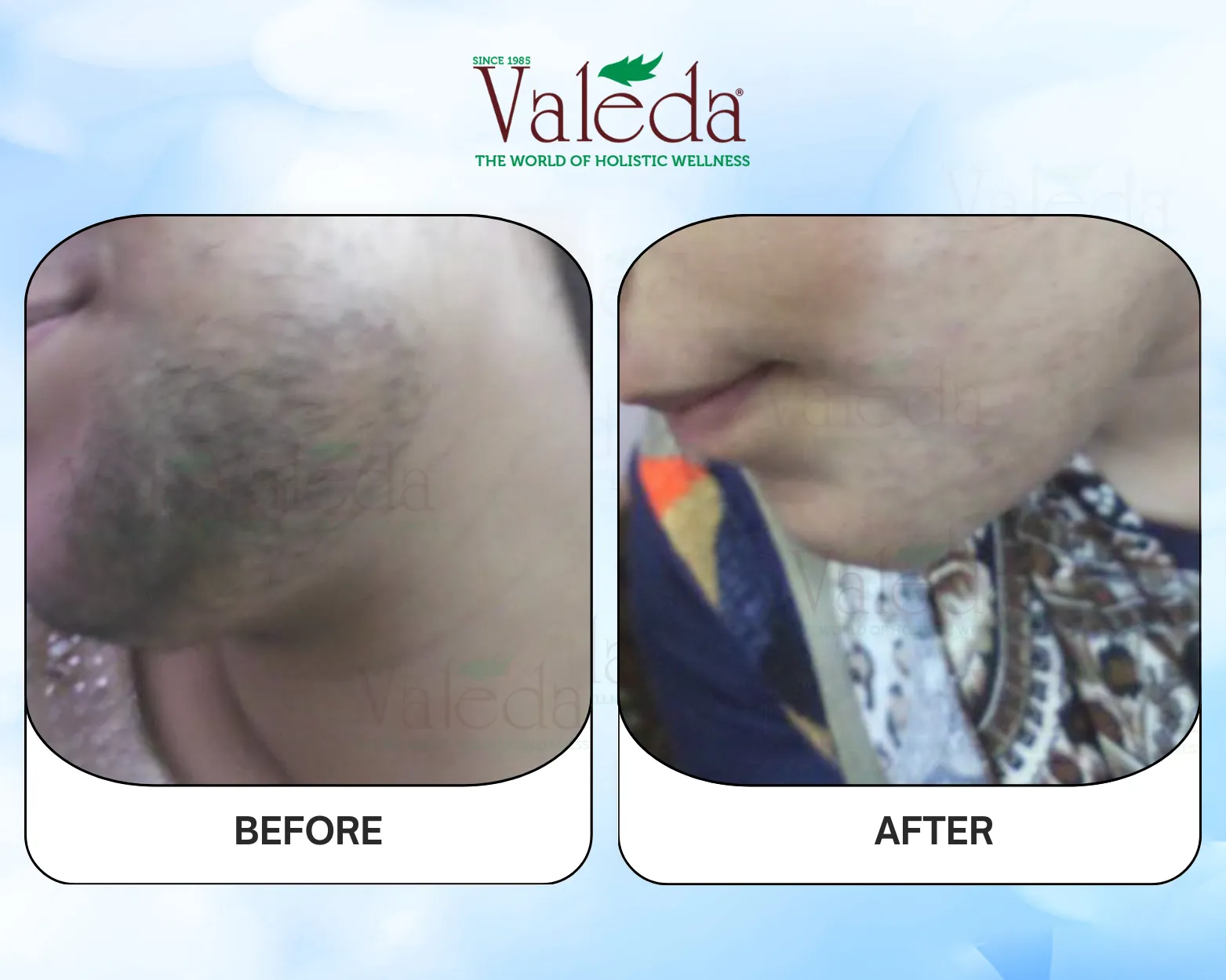 Permanent Hair Removal
