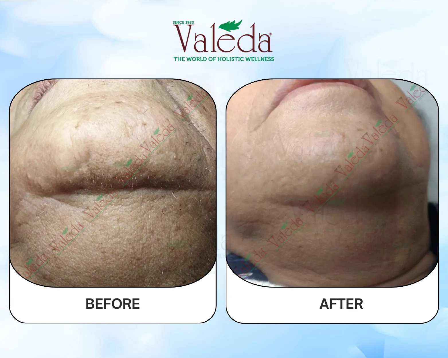 Permanent Hair Removal