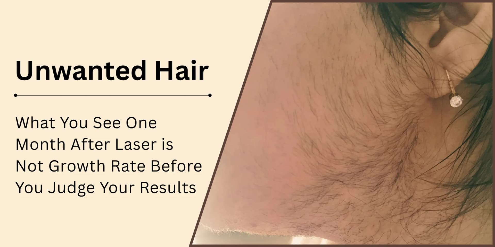 What You See One Month After Laser Is Not What's Really There: Understanding Hair Growth Rate Before You Judge Your Results