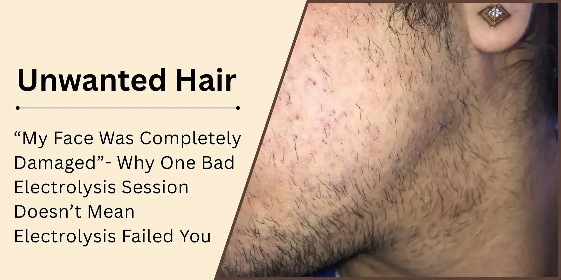 My Face Was Completely Damaged — Why One Bad Electrolysis Session Doesn't Mean Electrolysis Failed You