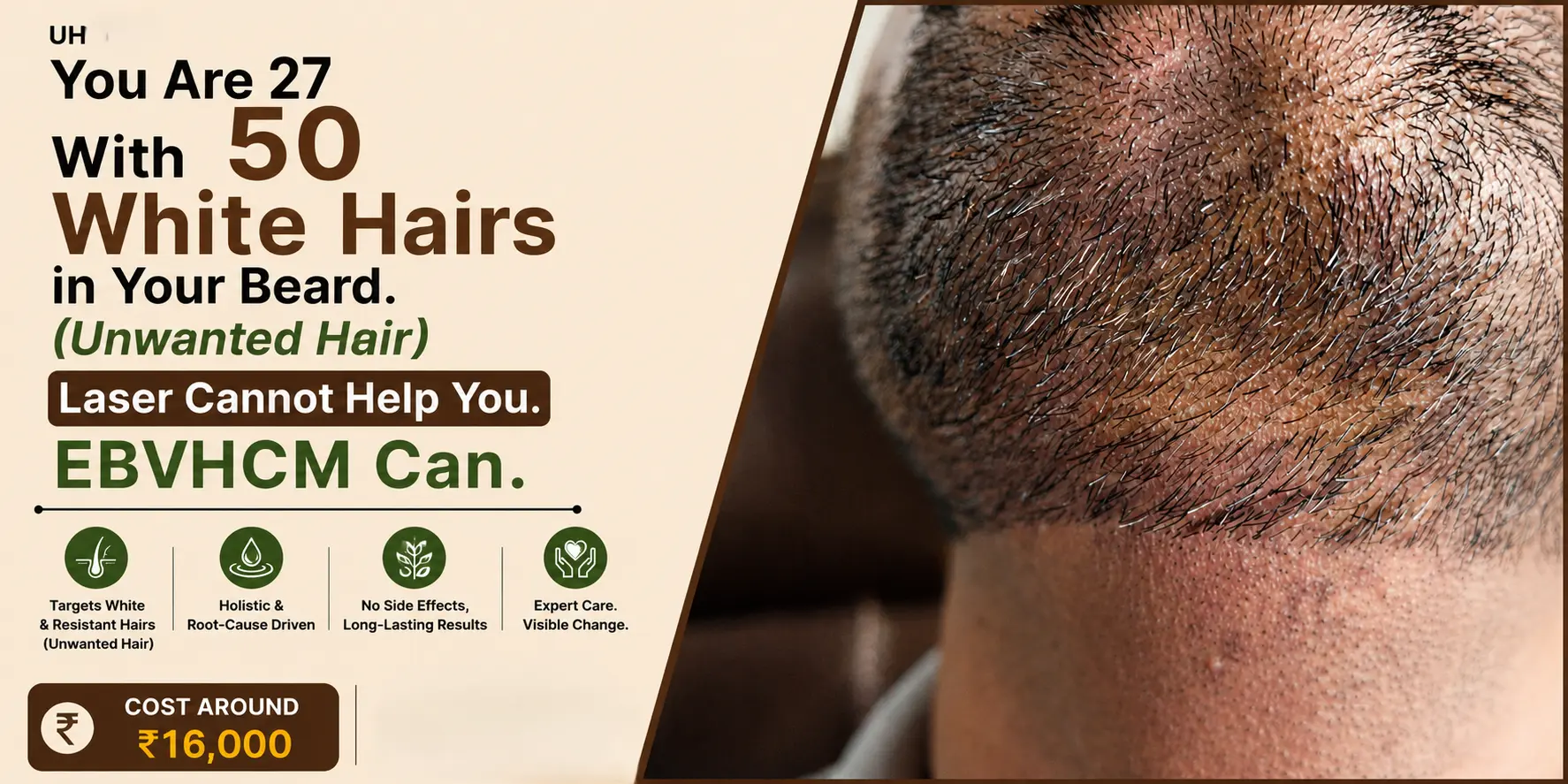 You Are 27 With 50 White Hairs in Your Beard. Laser Cannot Help You. EBVHCM Can.