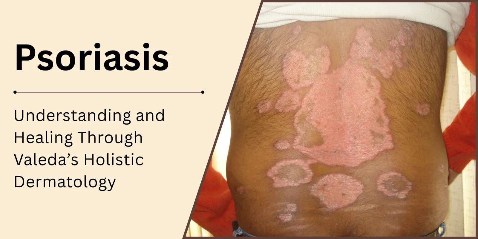 Psoriasis — Understanding and Healing Through Valeda’s Holistic Dermatology