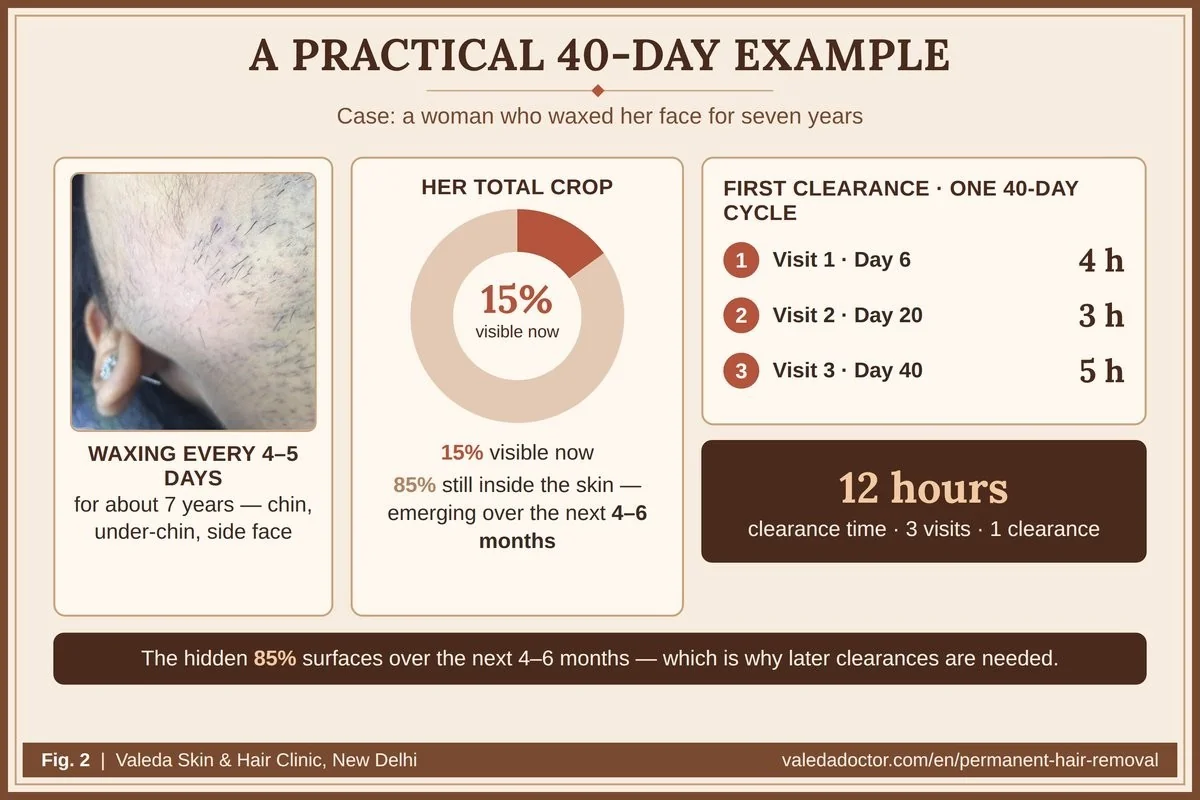 Case study: an Indian woman who waxed for seven years; her visible crop is only 15% of her total; first clearance of 12 hours over three visits on days 6, 20 and 40