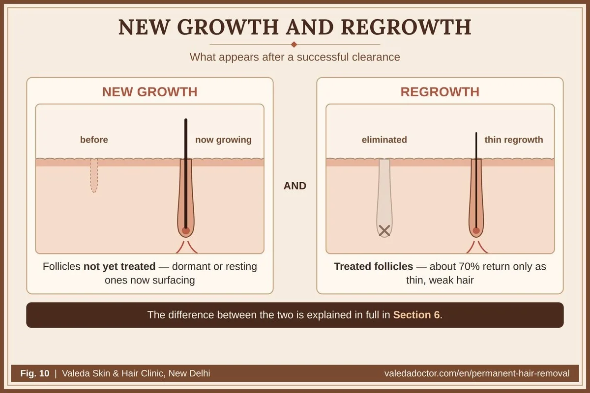 After a successful clearance two kinds of hair appear: new growth from follicles not yet treated, and regrowth from treated follicles, usually thin and weak