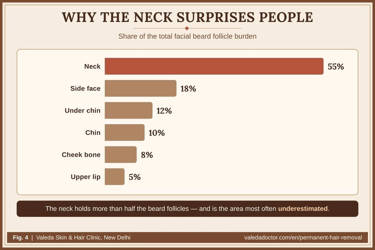Share of the total beard follicle burden by area: neck 55%, side face 18%, under chin 12%, chin 10%, cheek bone 8%, upper lip 5%