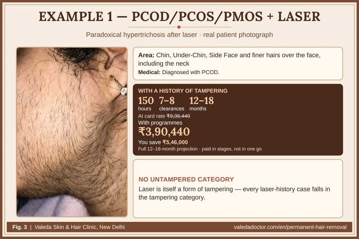 Real patient photograph for Example 1 (PCOD/PCOS/PMOS + laser-worsened hair) with hours, months and estimated total budget
