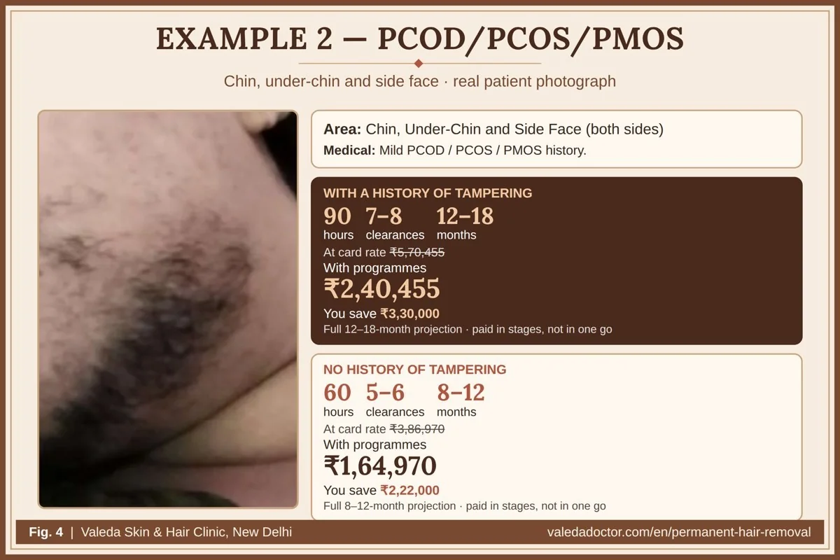Real patient photograph for Example 2 (PCOD/PCOS/PMOS — chin, under-chin, side face) with hours, months and estimated total budget