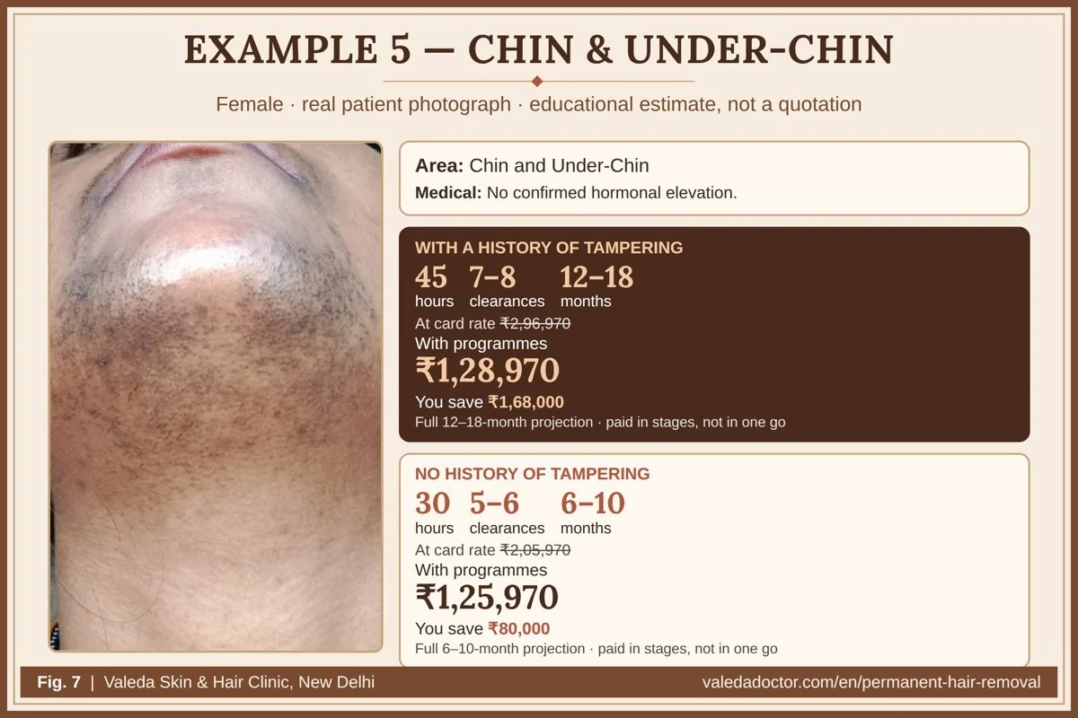Real patient photograph for Example 5 (Chin & under-chin) with hours, months and estimated total budget