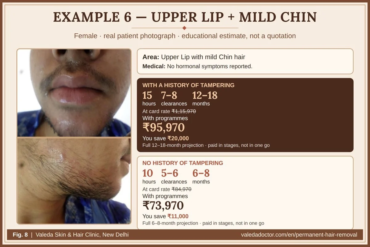 Real patient photograph for Example 6 (Upper lip + mild chin) with hours, months and estimated total budget