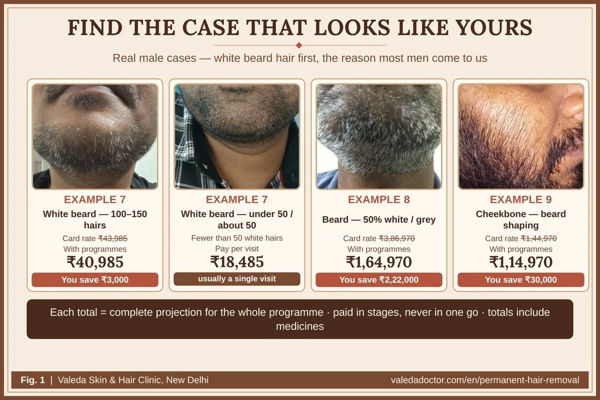 Four real male cases side by side — white beard hair, a few white hairs, 50% white beard and cheekbone shaping — each with card-rate and programme budget