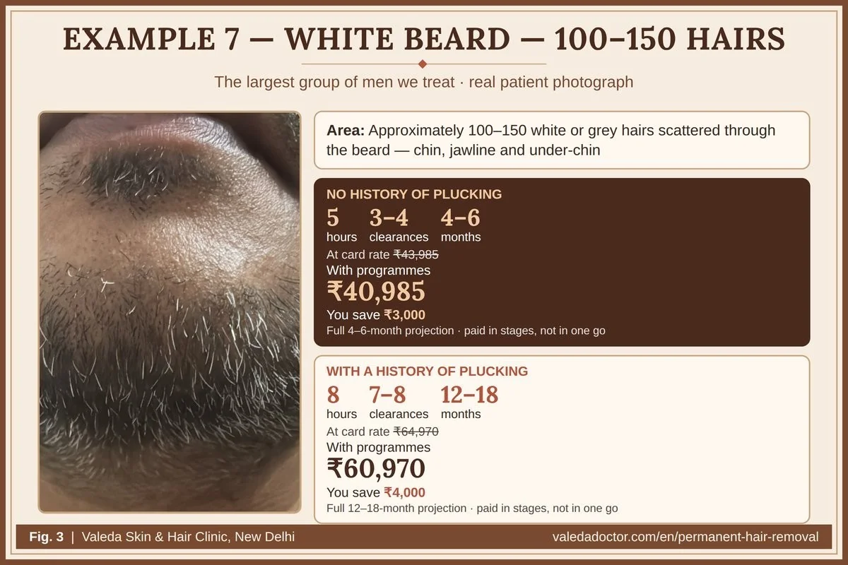 Real patient photograph for Example 7 (White beard — 100–150 hairs) with hours, clearances, months and budget