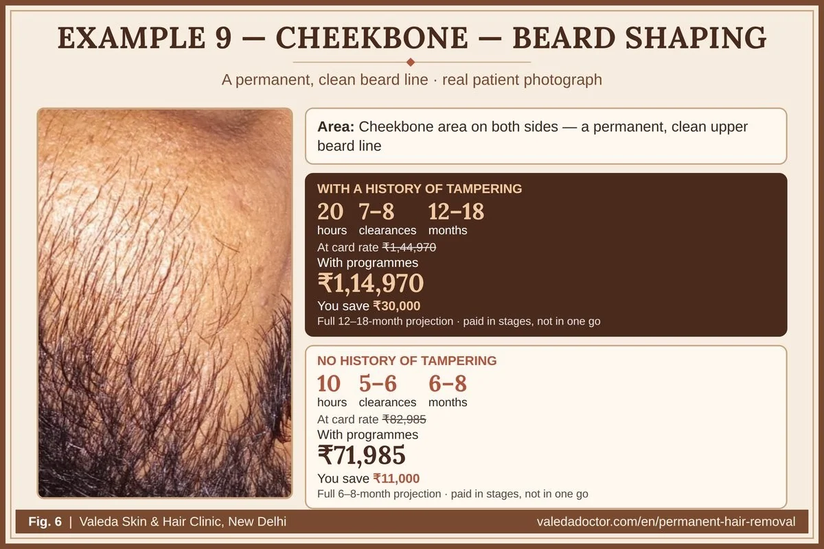 Real patient photograph for Example 9 (Cheekbone — beard shaping) with hours, clearances, months and budget