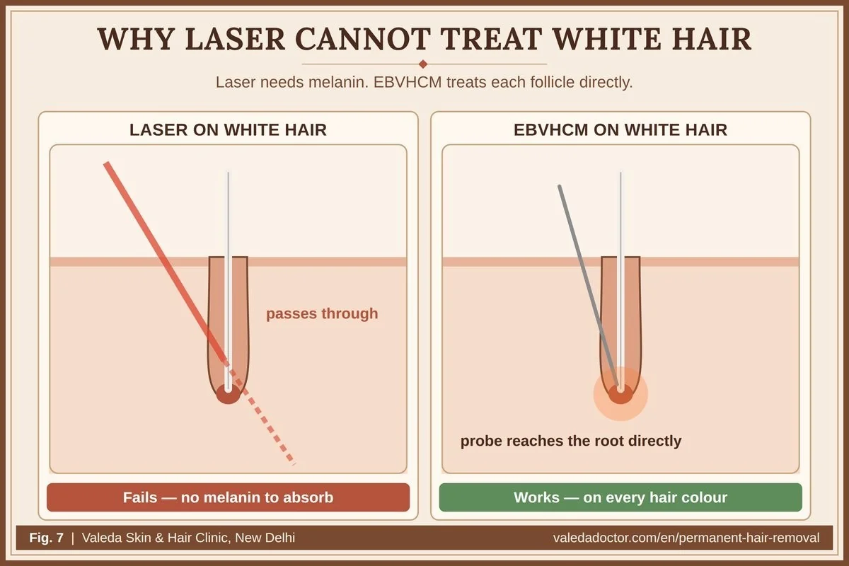 Why laser cannot treat white hair: laser energy is absorbed by melanin in dark hair; white hair has no melanin, while EBVHCM electrolysis treats each follicle directly, whatever its colour