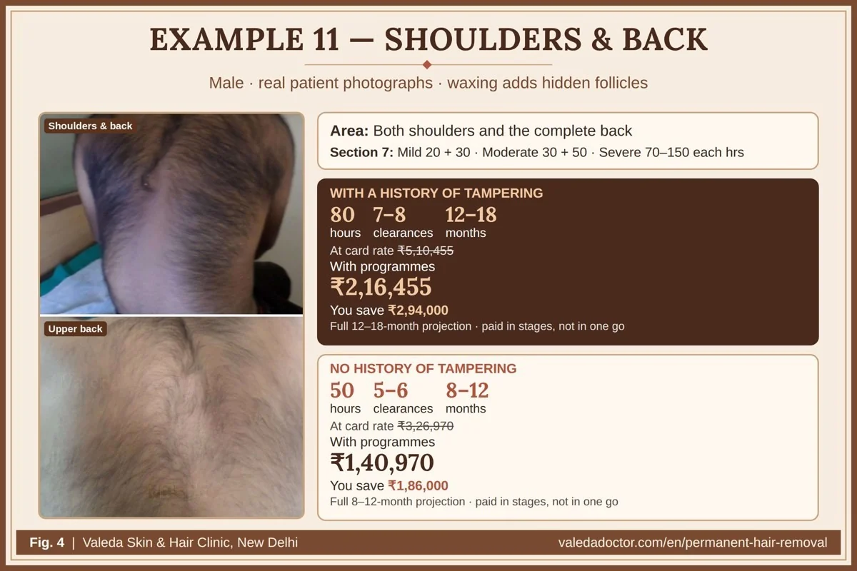 Real patient photographs for Example 11 (Shoulders & back) with hours, clearances, months and budget