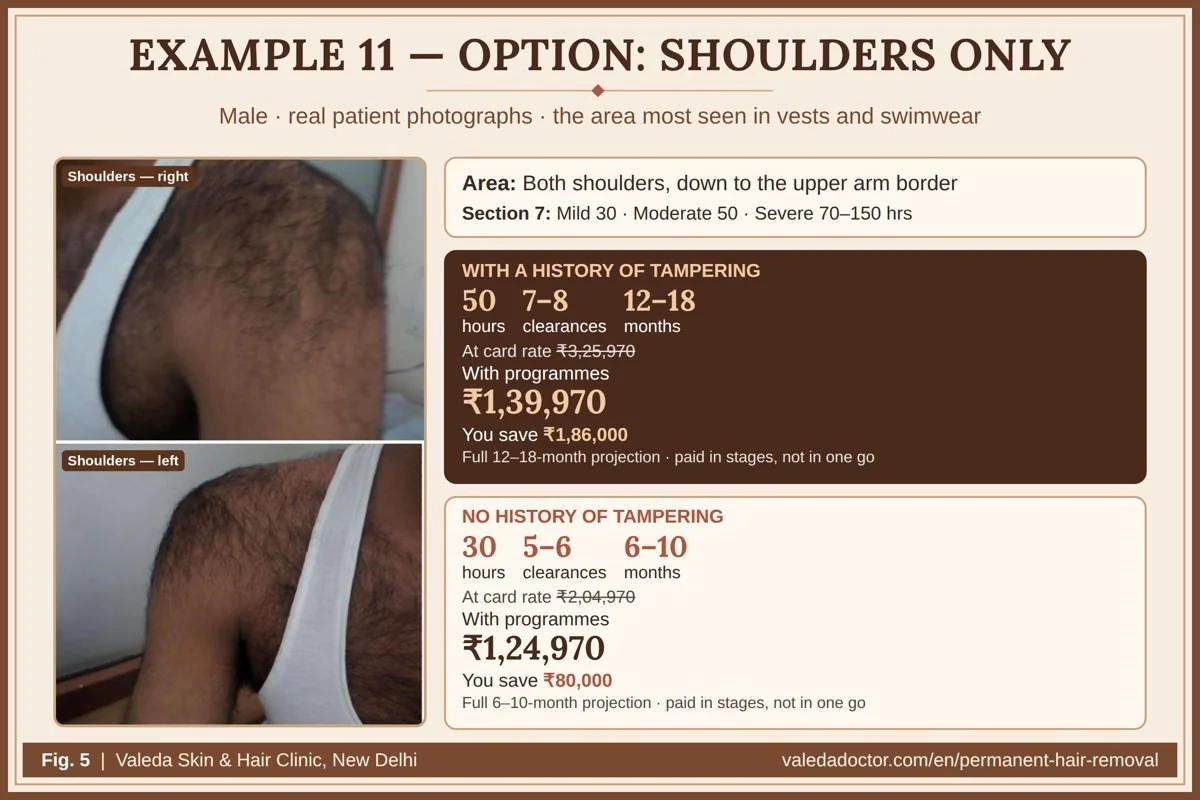 Real patient photographs for Example 11 (Shoulders only) with hours, clearances, months and budget