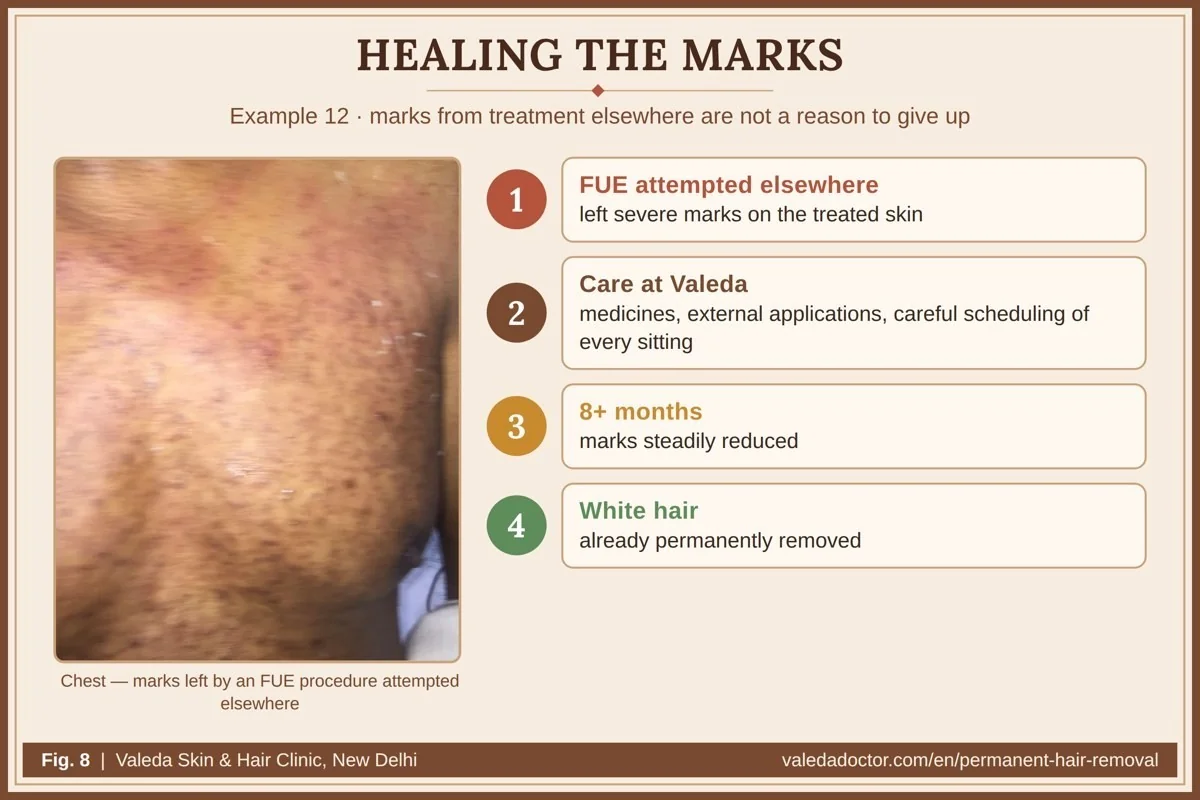 Recovery after an FUE procedure attempted elsewhere: severe marks reduced over more than eight months of care at Valeda, while the white hair has already been removed permanently