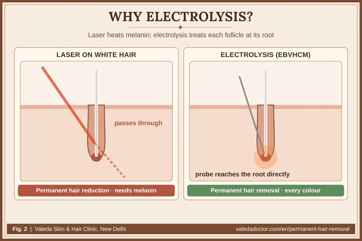 Why electrolysis: laser targets melanin and gives only permanent hair reduction, while electrolysis treats each follicle directly, works on every hair colour and is recognised as permanent hair removal