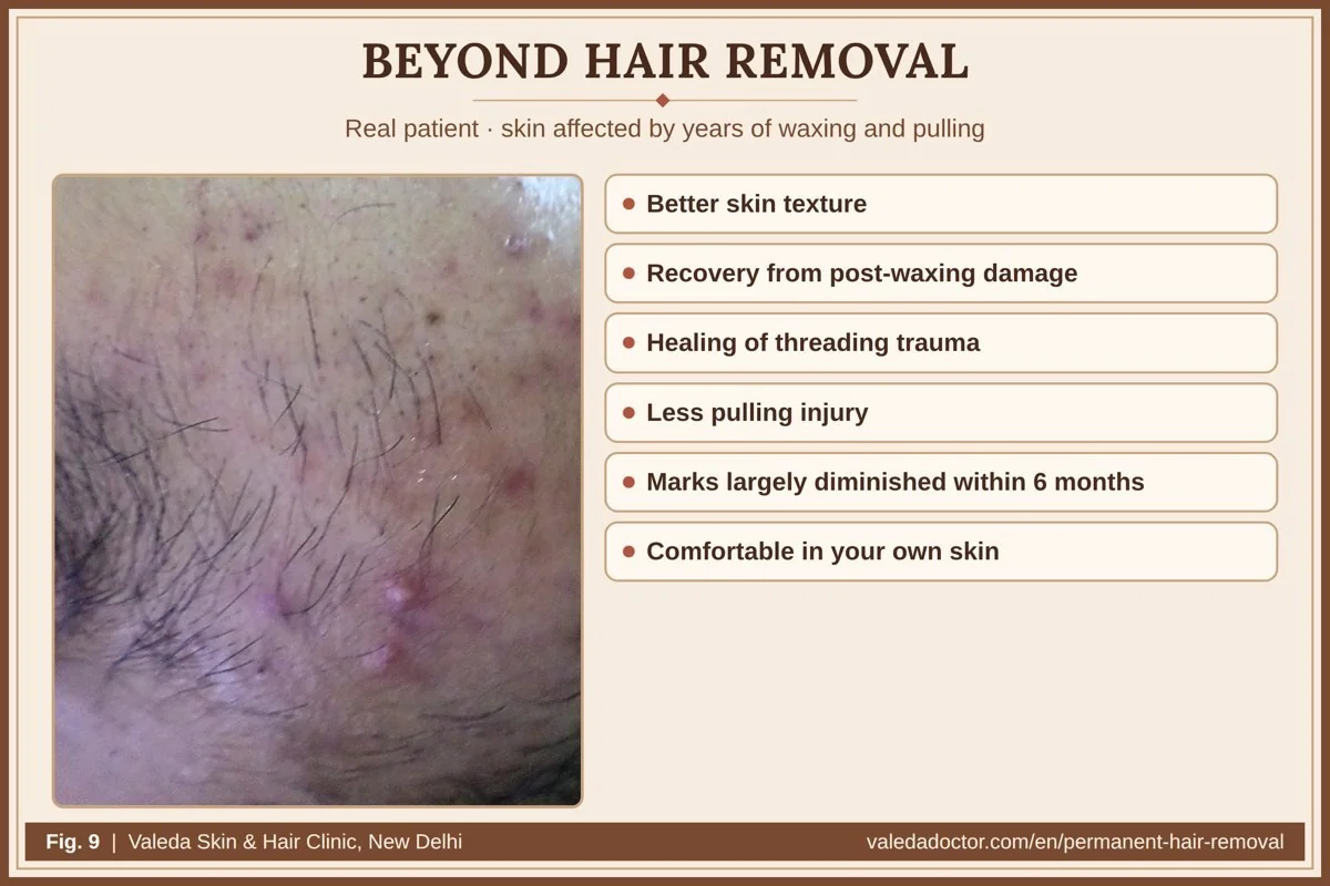Real patient photograph showing post-waxing skin damage; beyond hair removal, treatment often improves skin texture and confidence, with earlier marks largely diminishing within six months