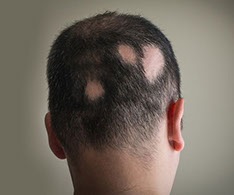 What is alopecia treatment?