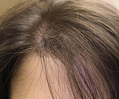 Hair Loss can be treated?